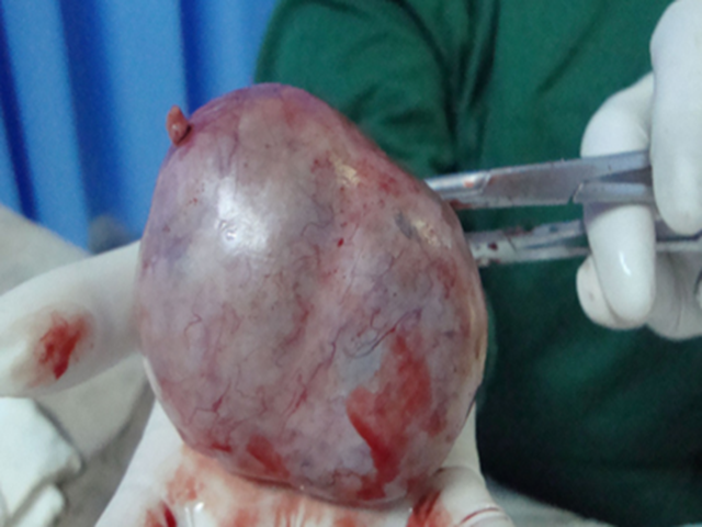 【围观】16岁花季少女“怀了个怪胎”,重达8斤......(图2) 微信图片_20240913092559.png