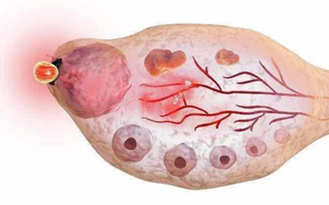 【围观】16岁花季少女“怀了个怪胎”,重达8斤......(图4) 微信图片_20240913092608.png