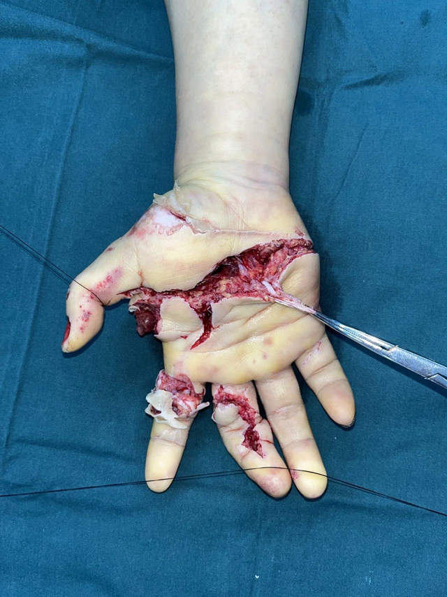 【围观】机器“吃人”，年轻女子被机器绞断手掌