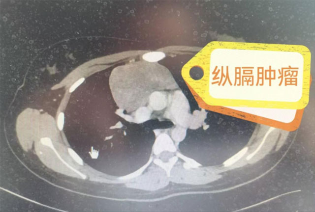 【警惕】16岁少女最终开胸手术……这些情况要重视！
