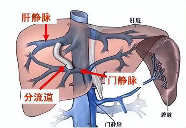 【警惕】大叔呕吐鲜血2000ml，最终……
