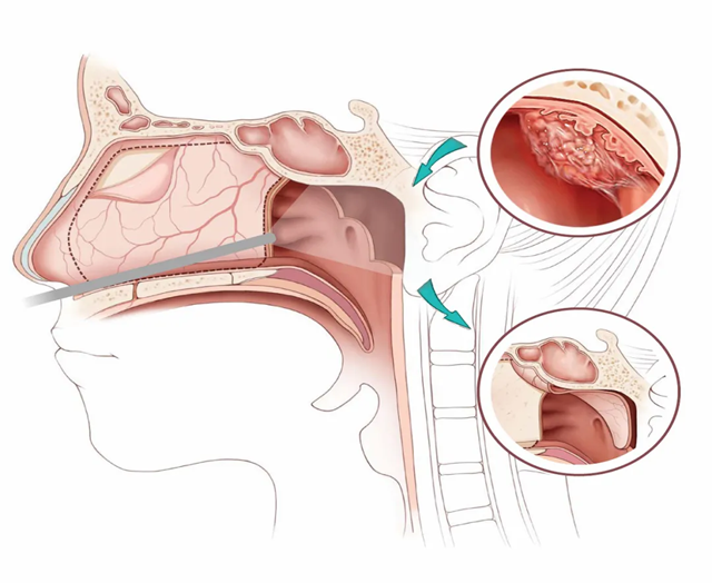 【围观】15岁男孩经常鼻塞流涕,一查竟是癌......(图2) 钟2.png