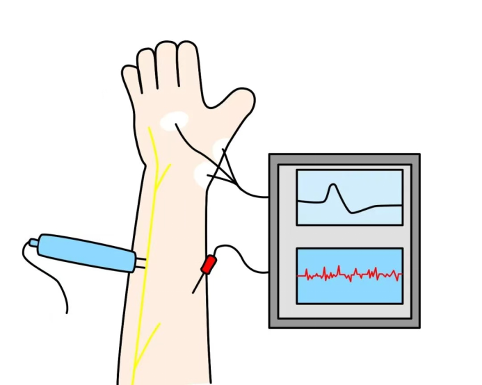 【技术】肌电图检查——让您的神经、肌肉会“说话”!(图2) 肌肉2.png