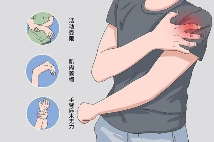 【技术】肌电图检查——让您的神经、肌肉会“说话”!(图5) 肌肉5.png