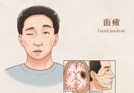 【科普】面瘫，你怕了吗？