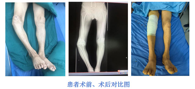 【专科技术】全膝人工关节置换术，让患者重燃行走“膝”望！