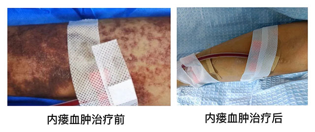 【病例分享】动静脉内瘘出现皮下血肿怎么办？