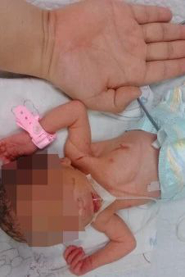 【手掌宝宝】当年仅970克的“小不点”，10岁啦！