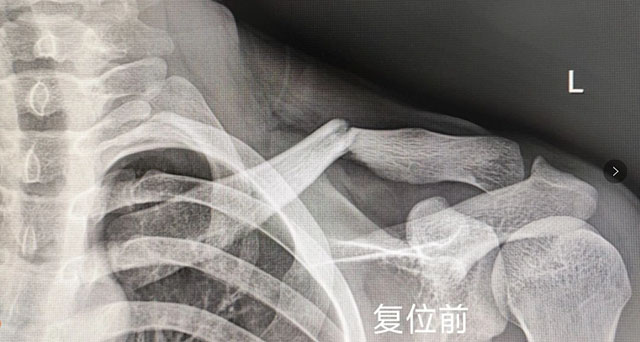 【围观】时隔一年，泸州又一“爬树哥”遭了