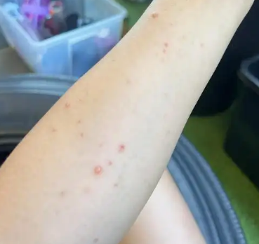 【警惕】多地发现，全班隔离！这种传染病出现新趋势