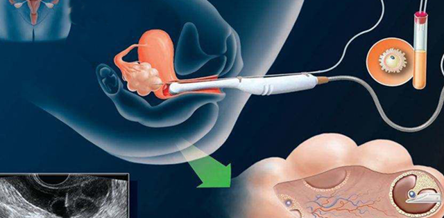 【医患故事】又一例!8年未孕夫妇怀上了……(图2) 怀2.png