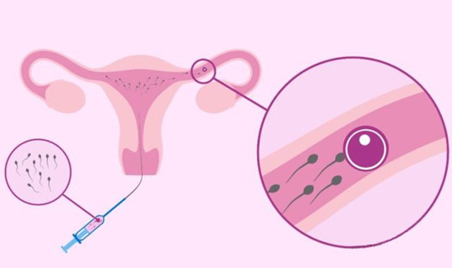 【医患故事】又一例!8年未孕夫妇怀上了……(图6) 怀6.png