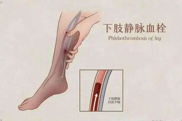 【关注】惊！置入滤器滞留男子体内长达6年，险些……