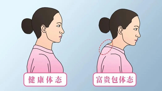 【科普讲堂】改善头前倾，消除富贵包，这4个动作超级有效！