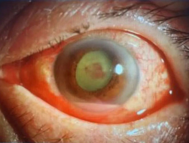 【围观】木签扎入眼中,泸州男子求医生挖掉眼睛(图2) 2.jpg