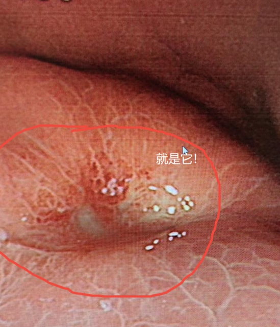 泸州大姐腹痛竟查出胃癌！医生：这样做保命又保胃！