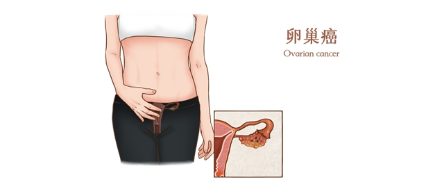 【扩散】女子腹痛不适竟确诊卵巢癌！出现这5个症状，一定要注意