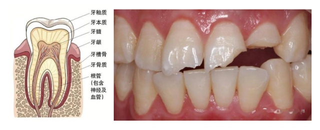 【口腔科普】守护牙齿健康，远离意外伤害！