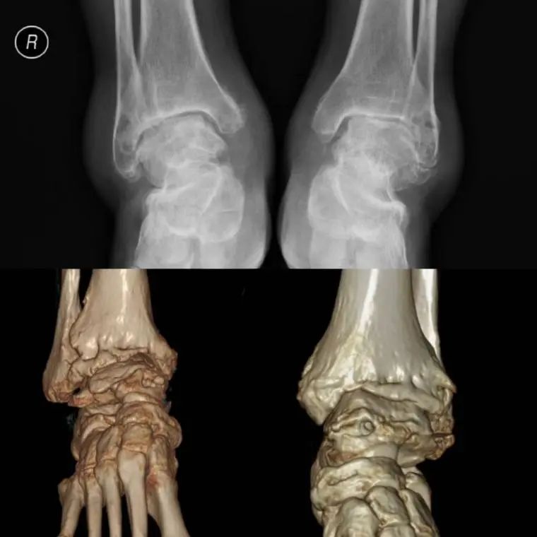 十余年寸步难行！川南首例“黑科技”踝关节置换术，让患者双踝重生！