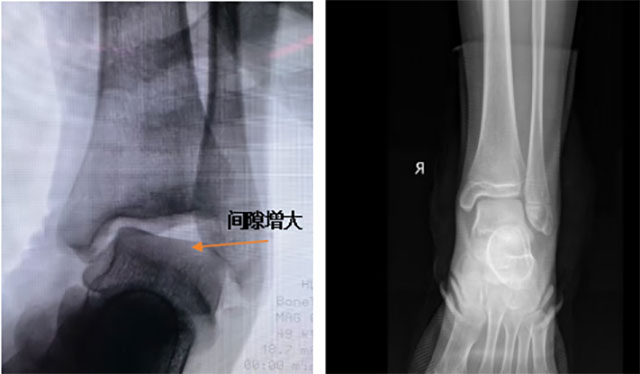 长期崴脚的朋友，注意了！