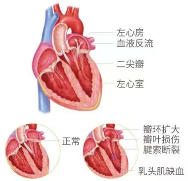 【精密】血液倒起流，医生在心尖上动刀修复心门
