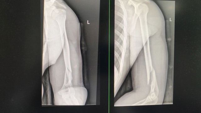 【围观】男子掰手腕,骨折了……(图2) 骨折2.jpg