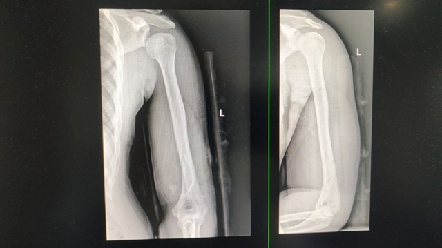 【围观】男子掰手腕,骨折了……(图5) 骨折5.jpg