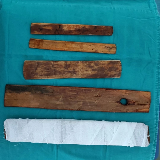 【围观】男子掰手腕,骨折了……(图8) 骨折8.jpg