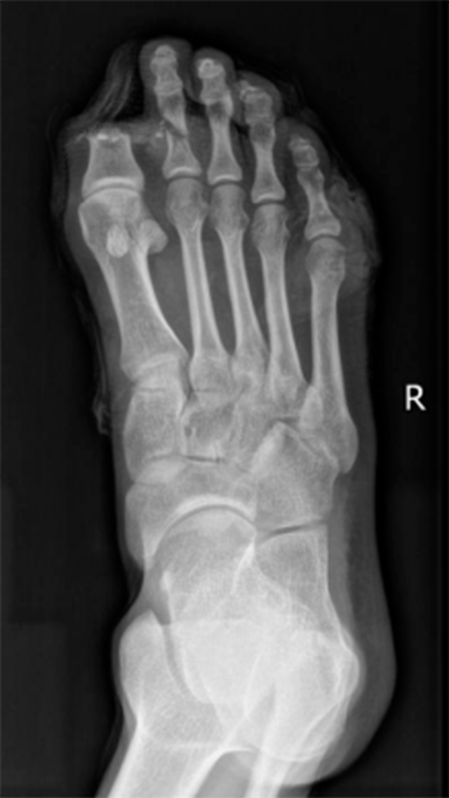 【可怕】男子脚趾硬生生被切断……(图2) 640.jpg