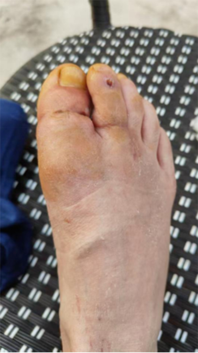 【可怕】男子脚趾硬生生被切断……(图5) 640-(4).jpg