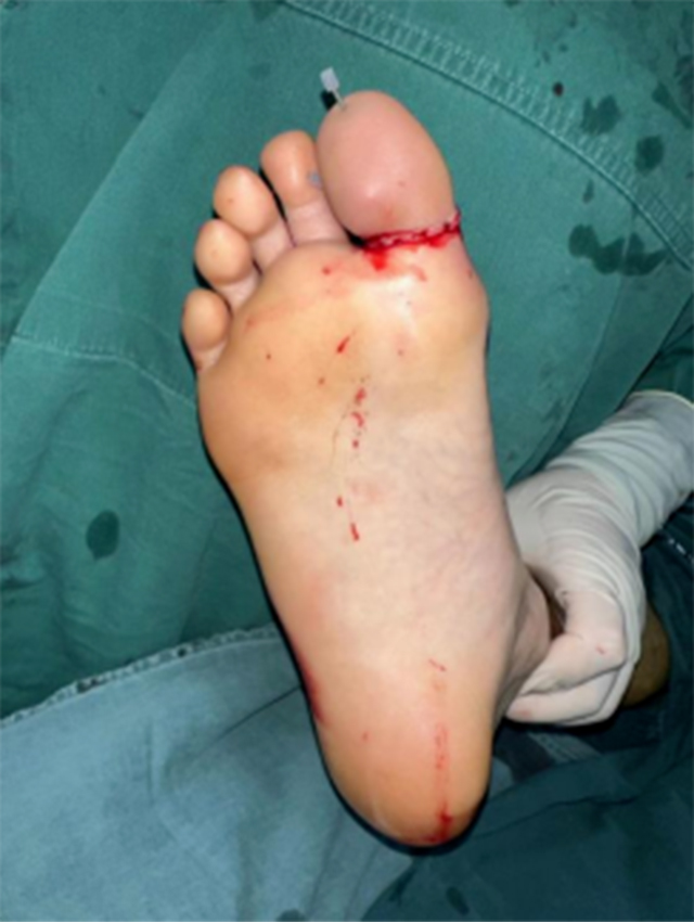 【可怕】男子脚趾硬生生被切断……(图3) 640-(2).jpg