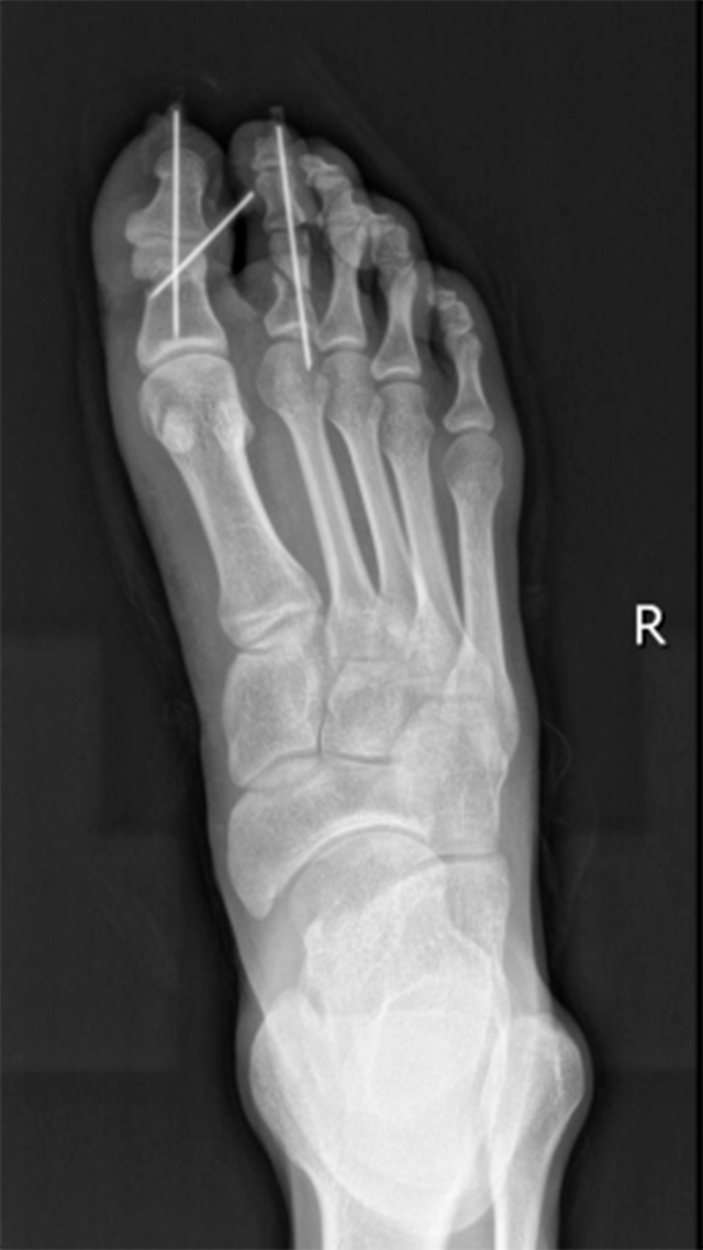 【可怕】男子脚趾硬生生被切断……(图4) 640-(3).jpg