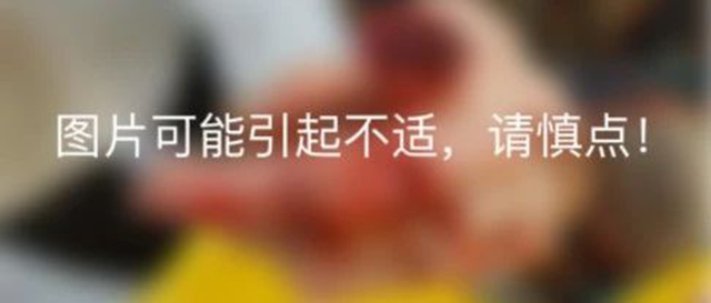 惊！一患者因故绞断手指，竟将断指浸泡在酒精里保存……