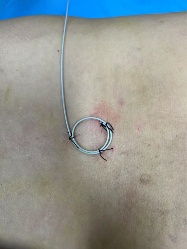 【围观】男子会阴长满疱疹,刺痛不已……(图3) 640-(4).jpg