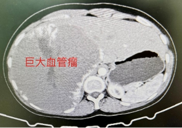 西南医大中医院完成建院以来最大血管瘤体腔镜下切除手术