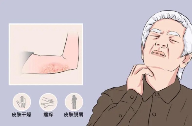 老年瘙痒症：72岁的老伯，全身痒得睡不着！