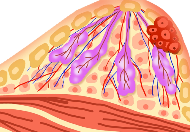 【警惕】12岁女孩胸部“发育”,一查竟是乳腺结节!快自查……(图2) 2.jpg