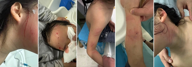 【注意】9岁小女孩被猫扑咬，浑身都是伤！