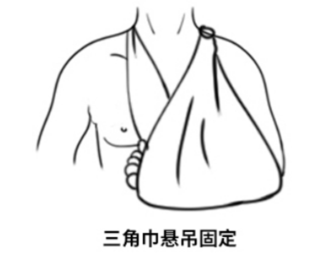 【关注】男童锁骨摔成两截……