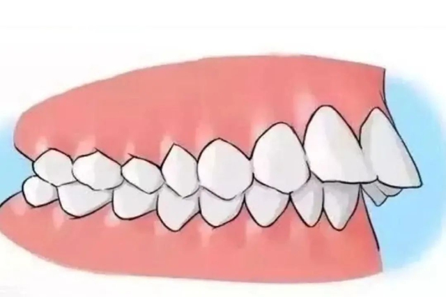 【扩散】“龅牙巴”引热议!咋回事?该咋治?(图1) 6401.jpg