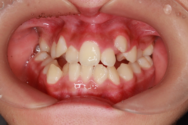 【扩散】“龅牙巴”引热议!咋回事?该咋治?(图2) 6402.jpg