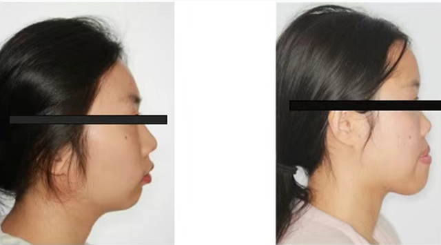 【扩散】“龅牙巴”引热议!咋回事?该咋治?(图3) 6403.jpg