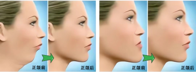 【扩散】“龅牙巴”引热议!咋回事?该咋治?(图4) 6404.jpg