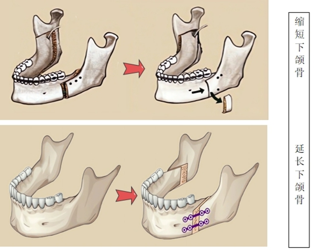【扩散】“龅牙巴”引热议!咋回事?该咋治?(图5) 6405.jpg
