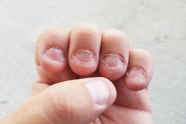 【警惕】孩子总啃咬指甲，可能是孩子的“求救信号”