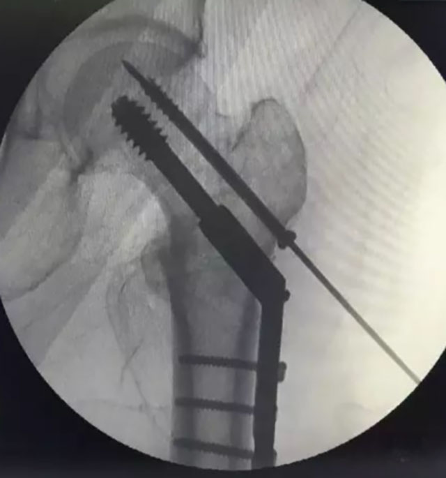 【当心】股骨颈骨折:这可能是你最后一次骨折!(图6) 6.jpg