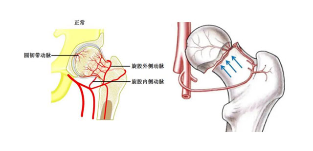 【当心】股骨颈骨折:这可能是你最后一次骨折!(图3) 3.jpg