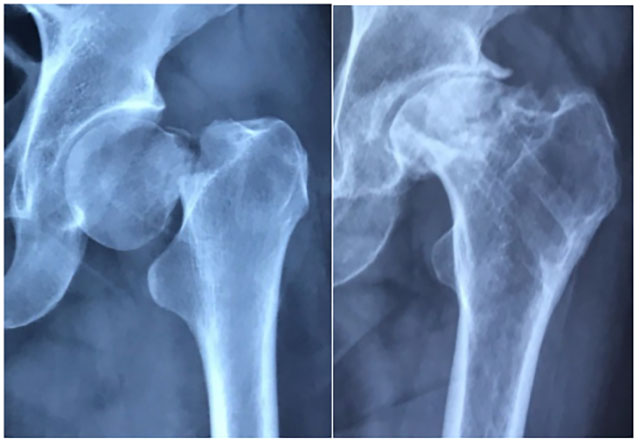 【当心】股骨颈骨折:这可能是你最后一次骨折!(图4) 4.jpg