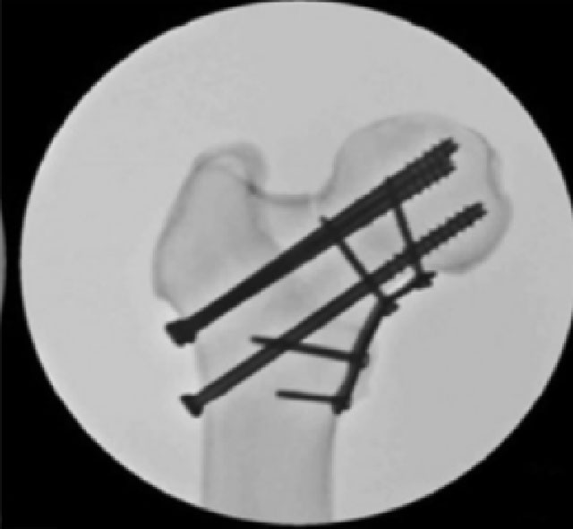 【当心】股骨颈骨折:这可能是你最后一次骨折!(图8) 8.jpg