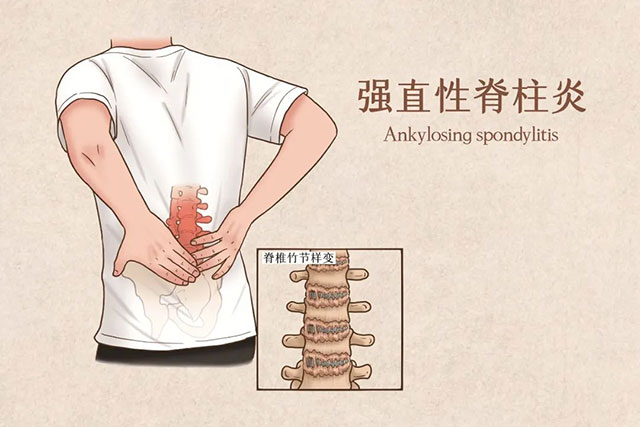 【围观】30岁小伙反复腰背疼痛,竟患“不死癌症”!医生:尚无根治方法(图5) 5.jpg